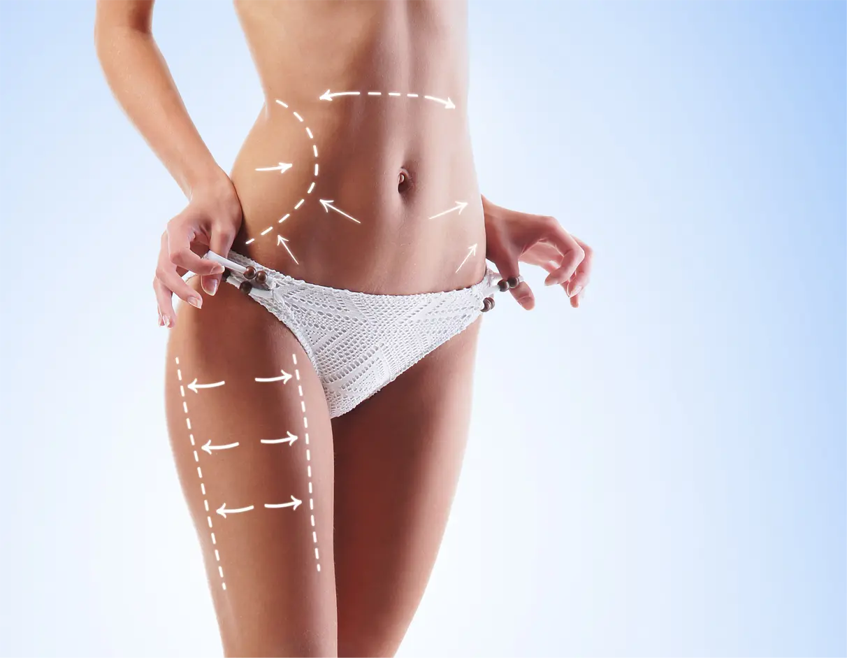 Partie ciała liposukcja nieoperacyjna Legnica – Queen Scarlet